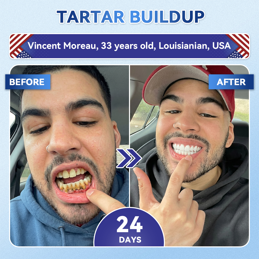 Your Smile~ SpringCherry® 🦷 Tideglusib Fast‑Dissolving Tooth & Gum Repair Oral Strips ✨ (𝟓-𝐢𝐧-𝟏 💎 𝐑𝐞𝐛𝐮𝐢𝐥𝐝 𝐄𝐧𝐚𝐦𝐞𝐥 & 𝐃𝐞𝐧𝐭𝐢𝐧 • 𝐒𝐭𝐫𝐞𝐧𝐠𝐭𝐡𝐞𝐧 𝐆𝐮𝐦𝐬 • 𝐄𝐫𝐚𝐝𝐢𝐜𝐚𝐭𝐞 𝐓𝐚𝐫𝐭𝐚𝐫 & 𝐎𝐝𝐨𝐫 • 𝐖𝐡𝐢𝐭𝐞𝐧𝐢𝐧𝐠 • 𝐒𝐭𝐨𝐩 𝐓𝐨𝐨𝐭𝐡 𝐒𝐞𝐧𝐬𝐢𝐭𝐢𝐯𝐢𝐭𝐲)