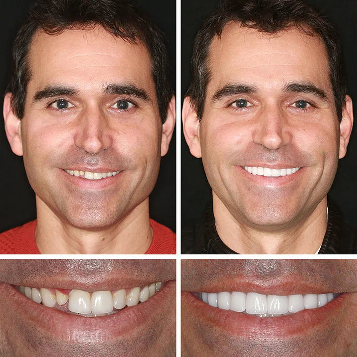 '--Ends Today: 75% OFF! ⏰DarkFairy™ Medical Full Denture with Strong Suctiond Custom-Fit Full Functional Dentures🦷