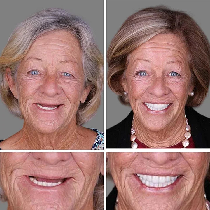 '--Ends Today: 75% OFF! ⏰DarkFairy™ Medical Full Denture with Strong Suctiond Custom-Fit Full Functional Dentures🦷