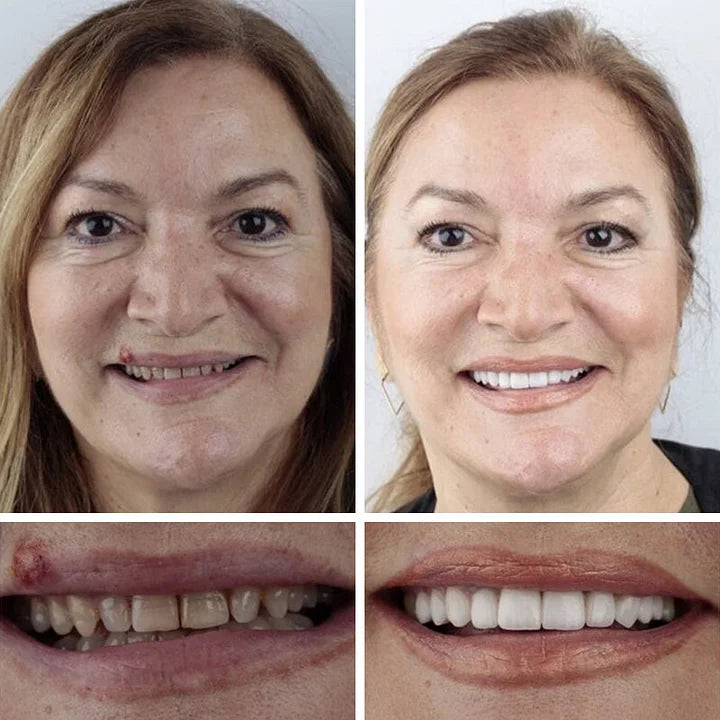 '--Ends Today: 75% OFF! ⏰DarkFairy™ Medical Full Denture with Strong Suctiond Custom-Fit Full Functional Dentures🦷