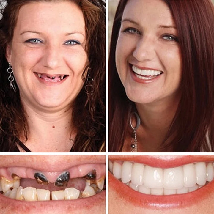 Ends Today ⏰ 70% OFF Exclusive Offer Pawoim™ Advanced Full Denture System 🦷 Pro-Level Suction Technology | Natural Aesthetic Fit | Daily Comfort Wear