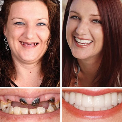 Ends Today ⏰ 70% OFF Exclusive Offer Pawoim™ Advanced Full Denture System 🦷 Pro-Level Suction Technology | Natural Aesthetic Fit | Daily Comfort Wear