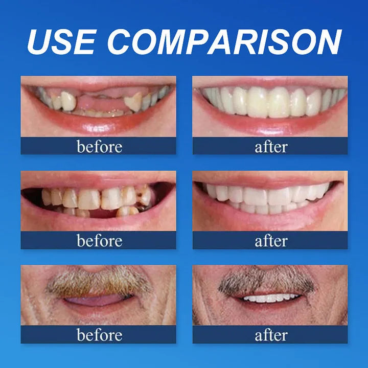'--Ends Today: 75% OFF! ⏰DarkFairy™ Medical Full Denture with Strong Suctiond Custom-Fit Full Functional Dentures🦷